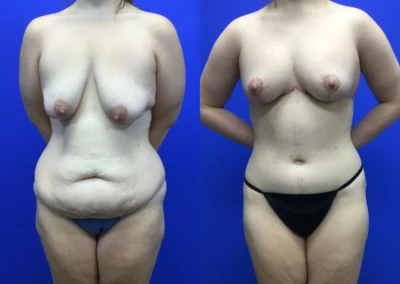 Fleur-de-lis tummy tuck before and after photos by Cabbabe Plastic Surgery in Saint Louis, MO