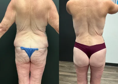 Back View Posterior thigh lift, Lower buttock lift before and after photos by Cabbabe Plastic Surgery