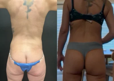 Back View lower buttock lift before and after photos by Cabbabe Plastic Surgery