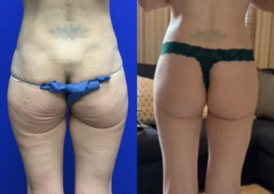Back View lower buttock lift before and after photos by Cabbabe Plastic Surgery