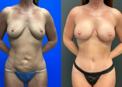 Front View Breast Augmentation before and after photos by Cabbabe Plastic Surgery