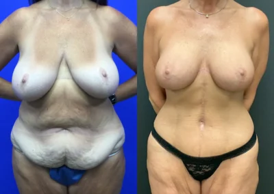 Front View Breast lift with implants before and after photos by Cabbabe Plastic Surgery