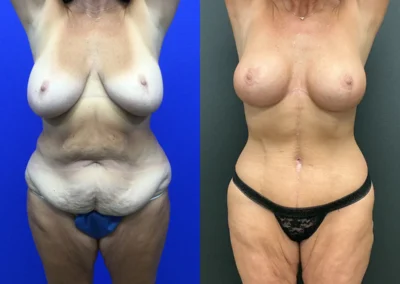 Front View Fleur de lis tummy tuck, Upper body lift before and after photos by Cabbabe Plastic Surgery