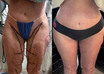 Front View Thigh Lift before and after photos by Cabbabe Plastic Surgery