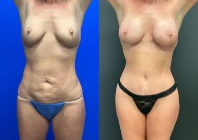 Front View Tummy tuck, mommy makeover, revision body conttouring before and after photos by Cabbabe Plastic Surgery