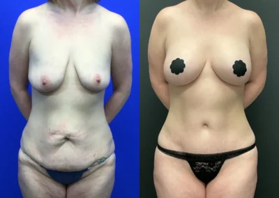 Front View breast lift with implant before and after photos by Cabbabe Plastic Surgery