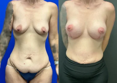 Front View breast lift with implant before and after photos by Cabbabe Plastic Surgery