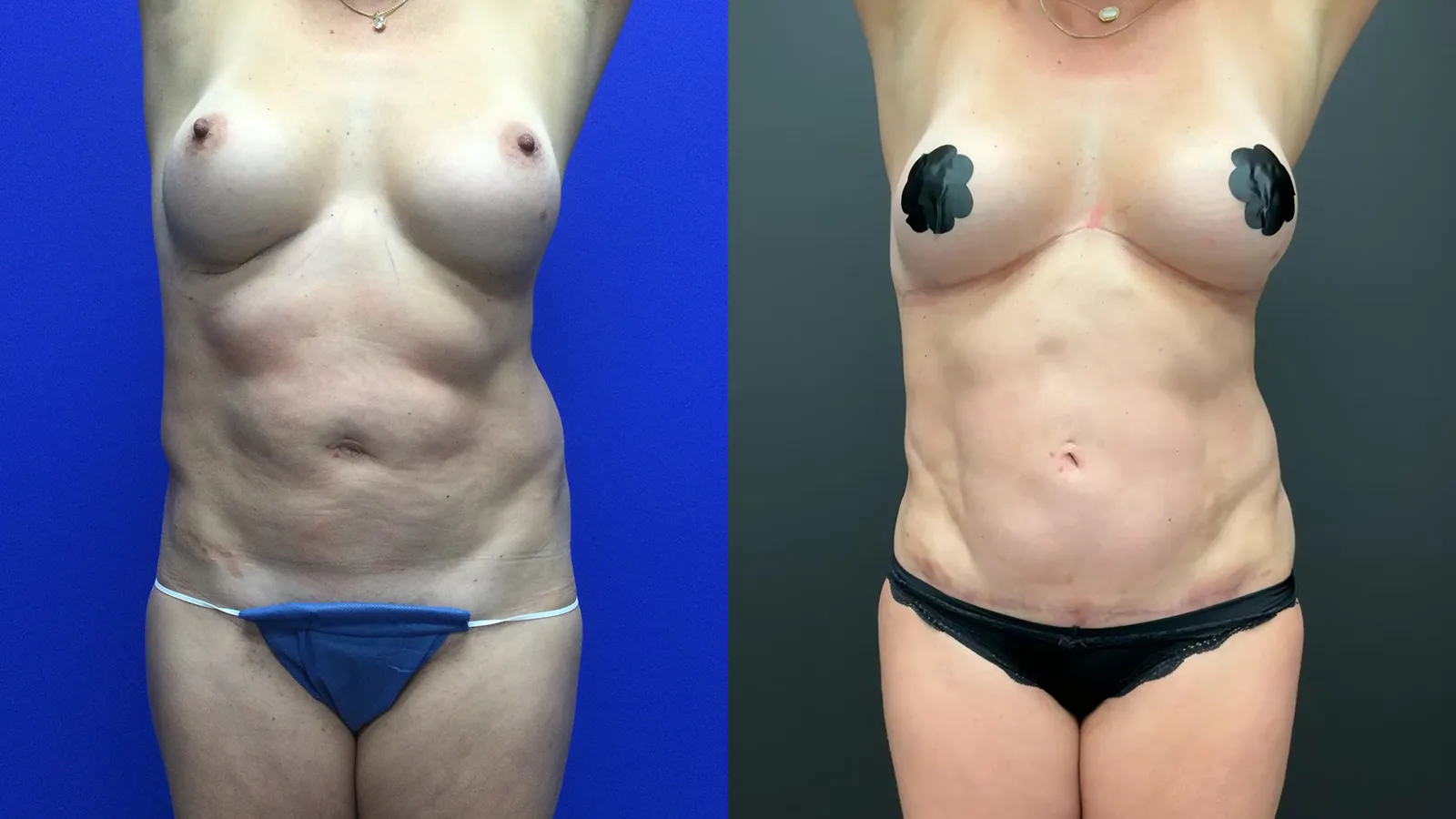 Front View dual reverse tummy tuck before and after photos by Cabbabe Plastic Surgery