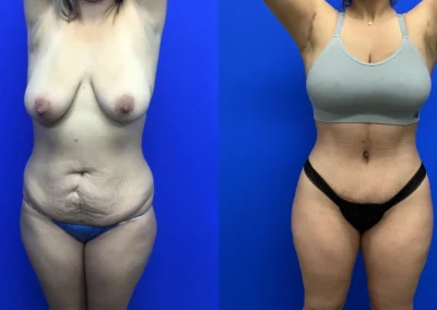 Front View lower body lift before and after photos by Cabbabe Plastic Surgery