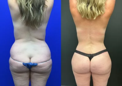 Back View brazilian butt lift before and after photos by Cabbabe Plastic Surgery