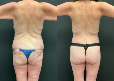 Back View lower buttock lift before and after photos by Cabbabe Plastic Surgery