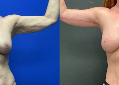 Front View arm lift before and after photos by Cabbabe Plastic Surgery