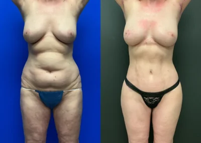 Front View lower body lift before and after photos by Cabbabe Plastic Surgery