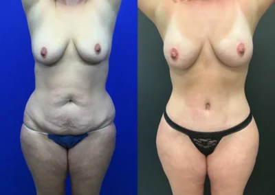 Front View lower body lift before and after photos by Cabbabe Plastic Surgery