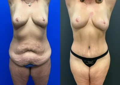 Front View lower lift before and after photos by Cabbabe Plastic Surgery