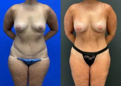 Front View revision body contouring before and after photos by Cabbabe Plastic Surgery