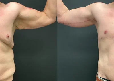 Front View arm lift before and after photos by Cabbabe Plastic Surgery