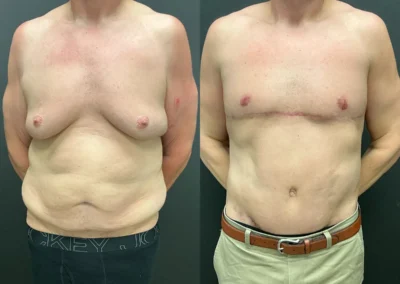 Front View male tummy tuck before and after photos by Cabbabe Plastic Surgery