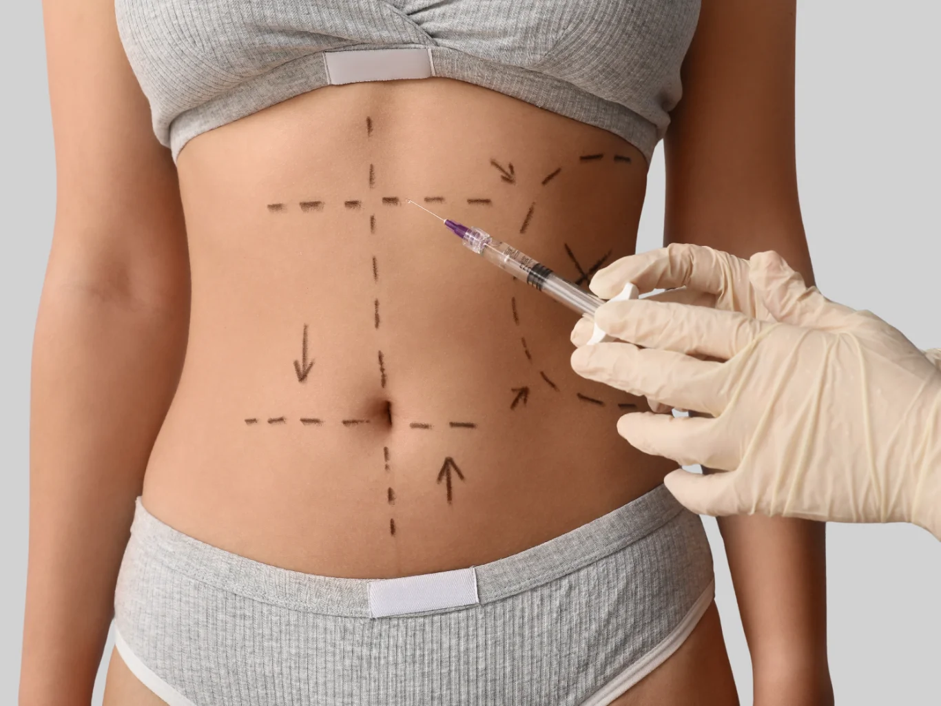 A gloved hand holding a syringe near a woman's abdomen, which has surgical markings drawn on it for a body contouring procedure. - Tummy Tuck