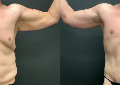 Front View arm lift before and after photos by Cabbabe Plastic Surgery