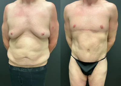 Front View chest lift, tummy tuck and lower body lift before and after photos by Cabbabe Plastic Surgery
