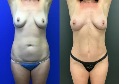 Front View dual tummy tuck and fat transfer breasts before and after photos by Cabbabe Plastic Surgery