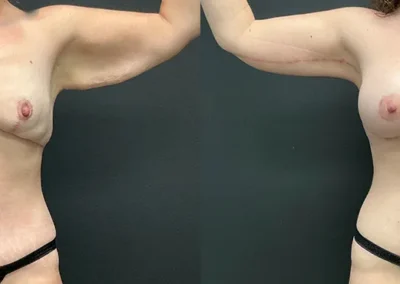 Front View arm lift before and after photos by Cabbabe Plastic Surgery